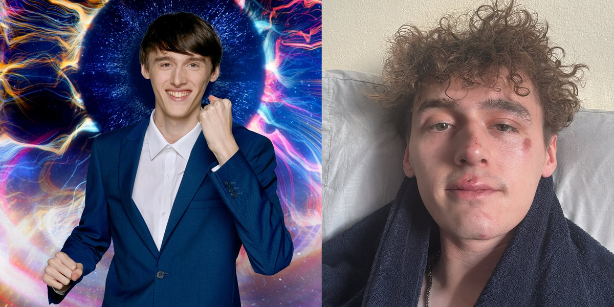 Big Brother winner Cameron Cole left with black eye after vicious homophobic attack