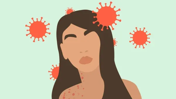 Umbrella Health Birmingham – monkeypox information